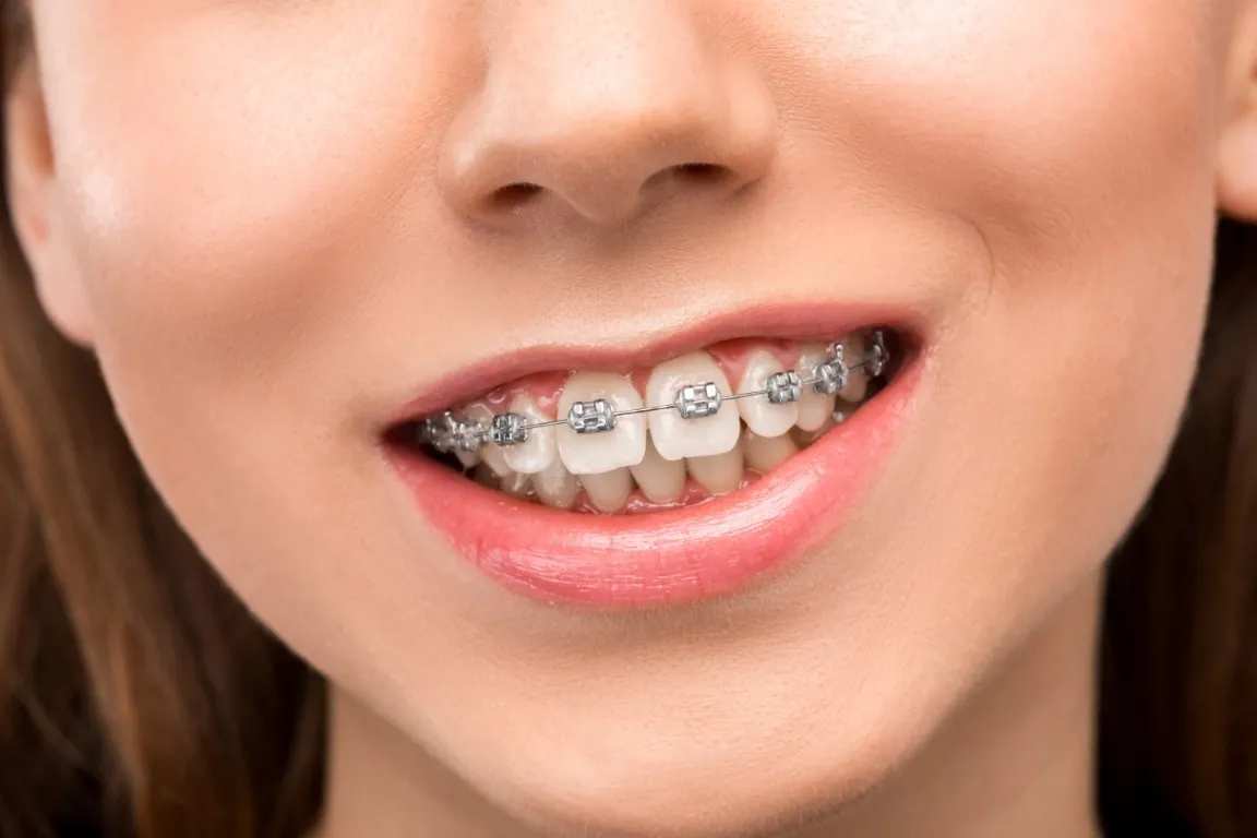 smile with braces